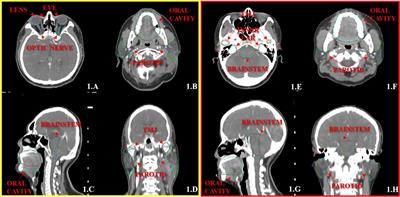 Evaluation Exploration of Atlas-Based and Deep Learning-Based Automatic Contouring for Nasopharyngeal Carcinoma